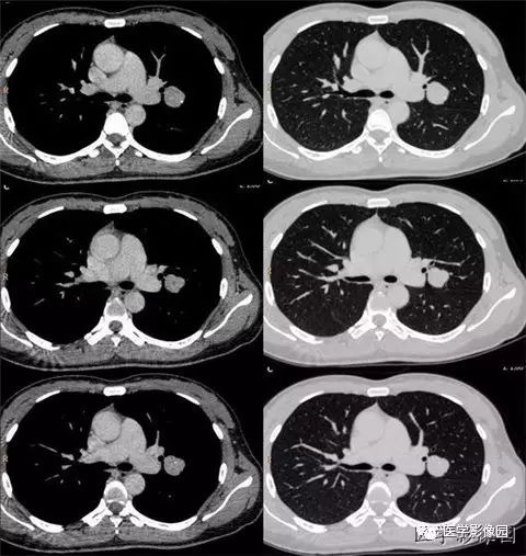 【病例】肺硬化性血管瘤1例CT 【病例】肺硬化性血管瘤1例CT