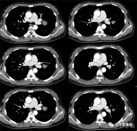 【病例】肺硬化性血管瘤1例CT 【病例】肺硬化性血管瘤1例CT