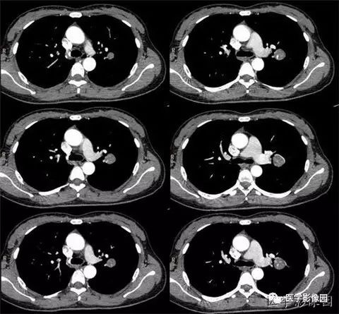 【病例】肺硬化性血管瘤1例CT