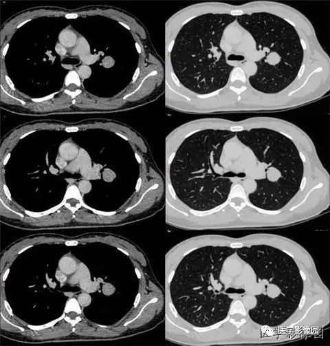 【病例】肺硬化性血管瘤1例CT 【病例】肺硬化性血管瘤1例CT