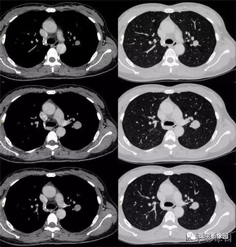 【病例】肺硬化性血管瘤1例CT 【病例】肺硬化性血管瘤1例CT
