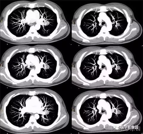 【病例】肺硬化性血管瘤1例CT 【病例】肺硬化性血管瘤1例CT