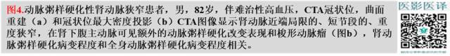 综述:肾血管病变的多模态影像学评估 综述:肾血管病变的多模态影像学评估