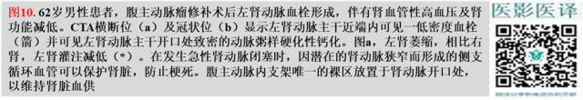 综述:肾血管病变的多模态影像学评估 综述:肾血管病变的多模态影像学评估