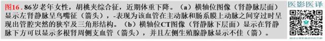 综述:肾血管病变的多模态影像学评估 综述:肾血管病变的多模态影像学评估