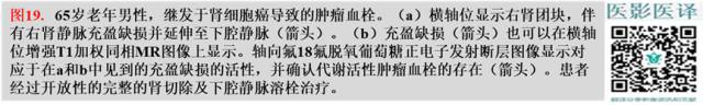 综述:肾血管病变的多模态影像学评估 综述:肾血管病变的多模态影像学评估
