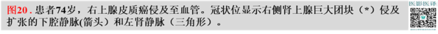 综述:肾血管病变的多模态影像学评估 综述:肾血管病变的多模态影像学评估