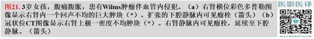 综述:肾血管病变的多模态影像学评估 综述:肾血管病变的多模态影像学评估
