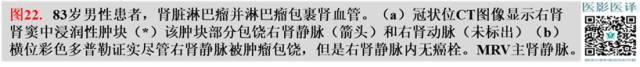综述:肾血管病变的多模态影像学评估 综述:肾血管病变的多模态影像学评估