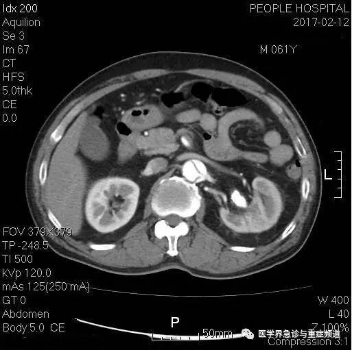 【病例】差点漏诊主动脉夹层,幸亏多看了眼CT 【病例】差点漏诊主动脉夹层,幸亏多看了眼CT