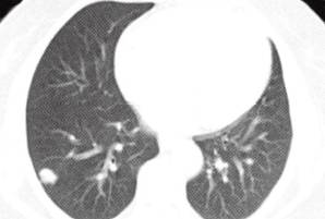 【病例】肺隐球菌病1例CT影像分析 【病例】肺隐球菌病1例CT影像分析