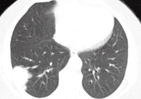 【病例】肺隐球菌病1例CT影像分析 【病例】肺隐球菌病1例CT影像分析