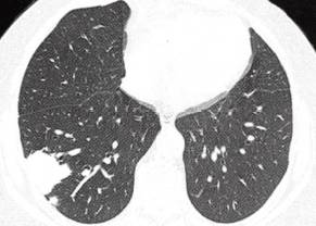 【病例】肺隐球菌病1例CT影像分析 【病例】肺隐球菌病1例CT影像分析