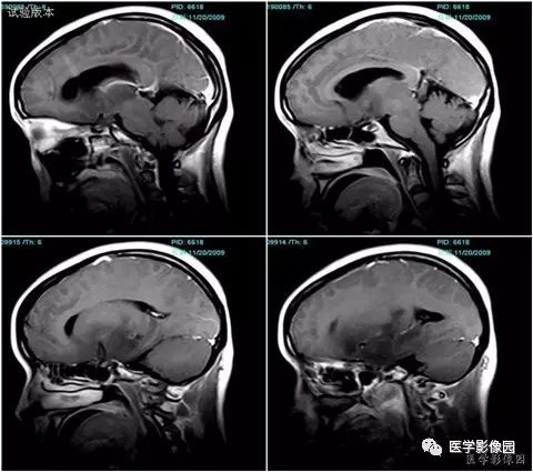 【病例】低级别星形细胞瘤1例CT及MR 【病例】低级别星形细胞瘤1例CT及MR