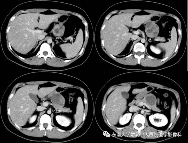 【病例】胰腺实性假乳状瘤1例CT影像表现