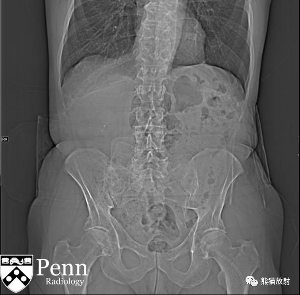 【双语病例】髓质海绵肾1例X线及CT鉴别诊断 【双语病例】髓质海绵肾1例X线及CT鉴别诊断