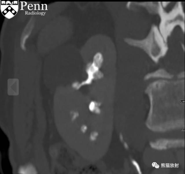 【双语病例】髓质海绵肾1例X线及CT鉴别诊断 【双语病例】髓质海绵肾1例X线及CT鉴别诊断