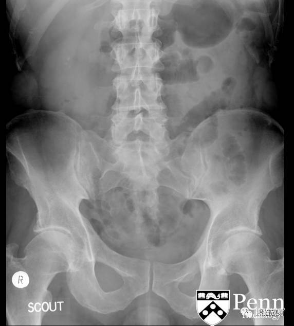 【双语病例】髓质海绵肾1例X线及CT鉴别诊断 【双语病例】髓质海绵肾1例X线及CT鉴别诊断