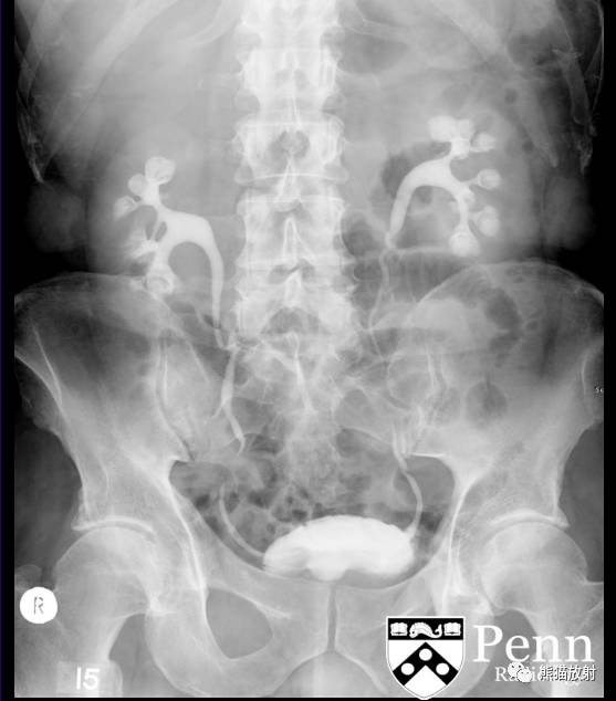 【双语病例】髓质海绵肾1例X线及CT鉴别诊断 【双语病例】髓质海绵肾1例X线及CT鉴别诊断