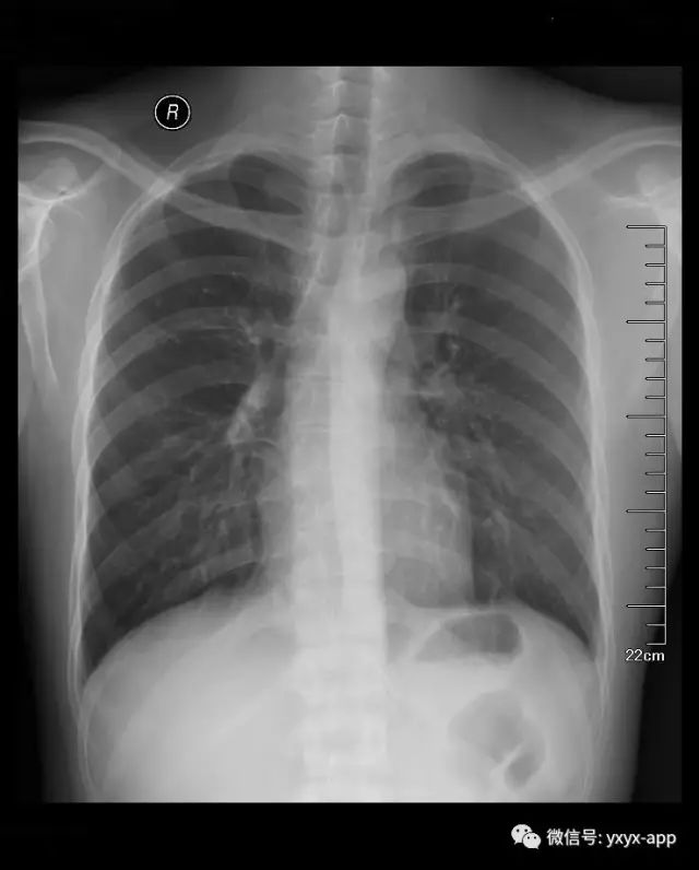【病例】肋骨纤维肉瘤1例CT 【病例】肋骨纤维肉瘤1例CT