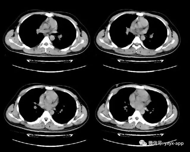 【病例】肋骨纤维肉瘤1例CT 【病例】肋骨纤维肉瘤1例CT