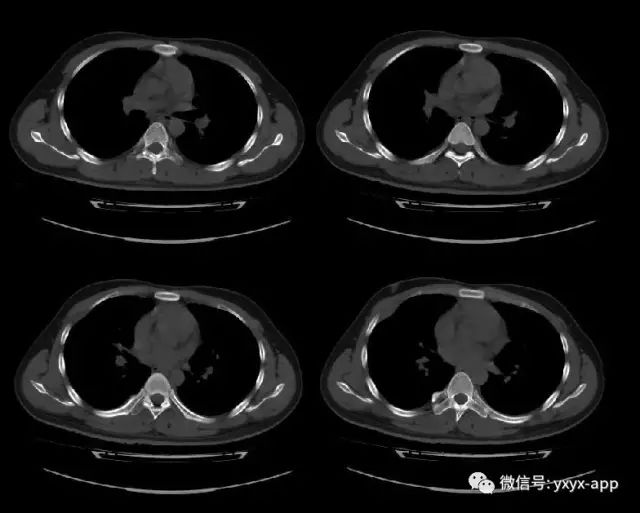 【病例】肋骨纤维肉瘤1例CT 【病例】肋骨纤维肉瘤1例CT
