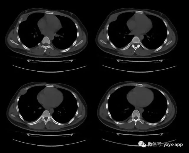 【病例】肋骨纤维肉瘤1例CT 【病例】肋骨纤维肉瘤1例CT
