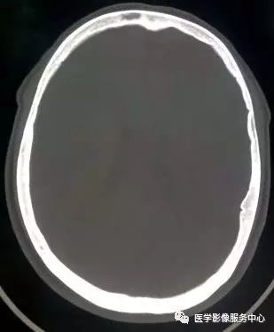 【三甲读片】光看CT,粗心的人会漏诊这例脑膜瘤 【三甲读片】光看CT,粗心的人会漏诊这例脑膜瘤