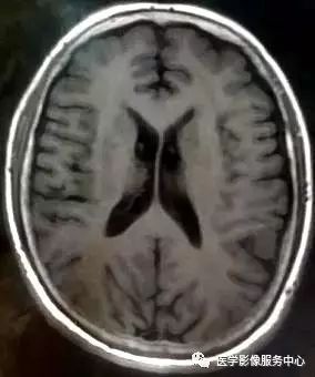 【三甲读片】光看CT,粗心的人会漏诊这例脑膜瘤 【三甲读片】光看CT,粗心的人会漏诊这例脑膜瘤