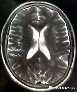 【三甲读片】光看CT,粗心的人会漏诊这例脑膜瘤 【三甲读片】光看CT,粗心的人会漏诊这例脑膜瘤