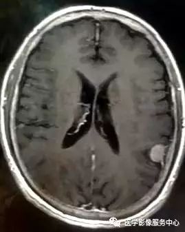 【三甲读片】光看CT,粗心的人会漏诊这例脑膜瘤 【三甲读片】光看CT,粗心的人会漏诊这例脑膜瘤