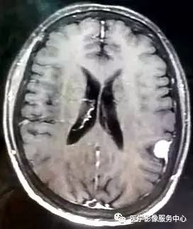 【三甲读片】光看CT,粗心的人会漏诊这例脑膜瘤 【三甲读片】光看CT,粗心的人会漏诊这例脑膜瘤