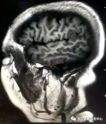 【三甲读片】光看CT,粗心的人会漏诊这例脑膜瘤 【三甲读片】光看CT,粗心的人会漏诊这例脑膜瘤