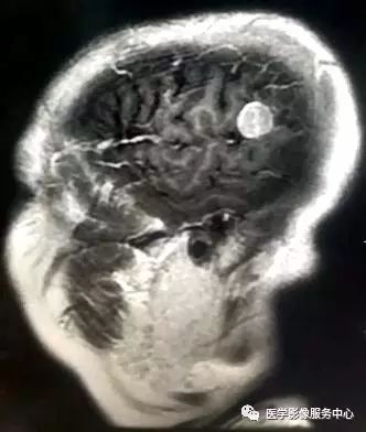 【三甲读片】光看CT,粗心的人会漏诊这例脑膜瘤 【三甲读片】光看CT,粗心的人会漏诊这例脑膜瘤