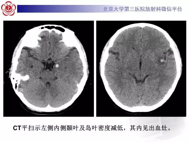 【病例】单纯疱疹病毒性脑炎1例CT及MR