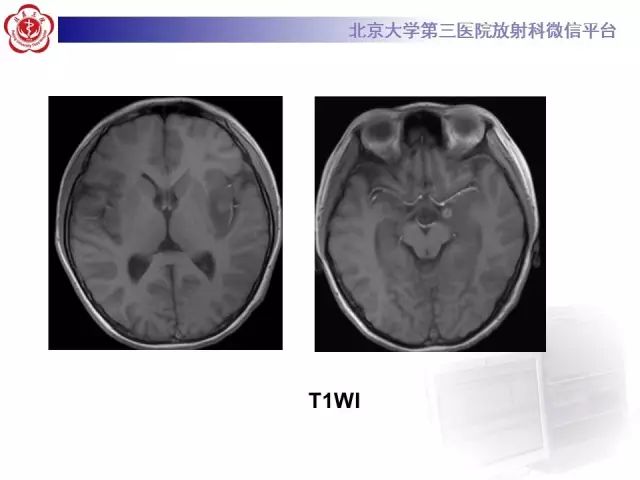 【病例】单纯疱疹病毒性脑炎1例CT及MR