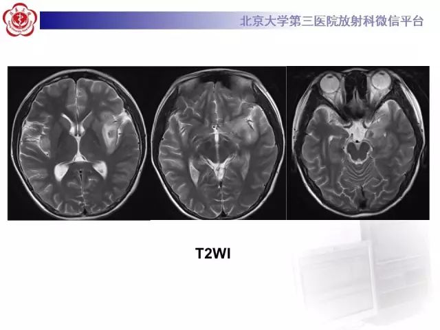 【病例】单纯疱疹病毒性脑炎1例CT及MR