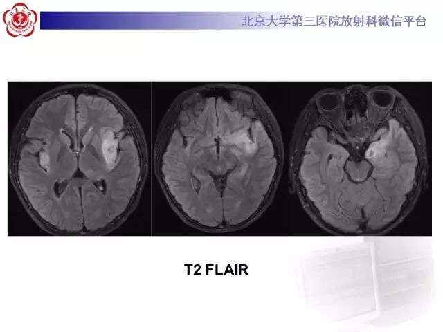 【病例】单纯疱疹病毒性脑炎1例CT及MR