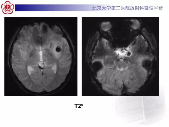 【病例】单纯疱疹病毒性脑炎1例CT及MR