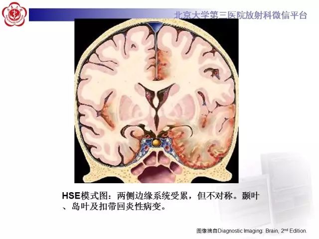 【病例】单纯疱疹病毒性脑炎1例CT及MR
