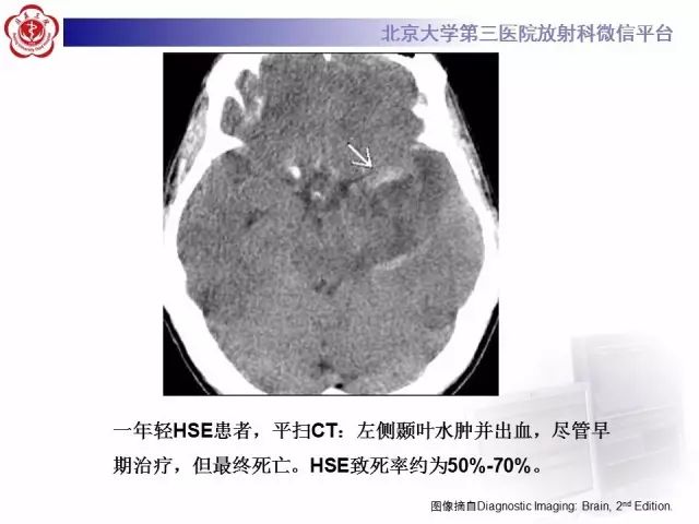 【病例】单纯疱疹病毒性脑炎1例CT及MR