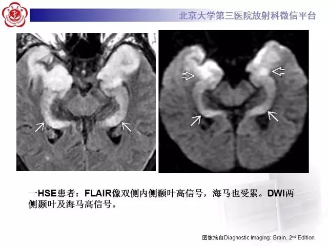 【病例】单纯疱疹病毒性脑炎1例CT及MR