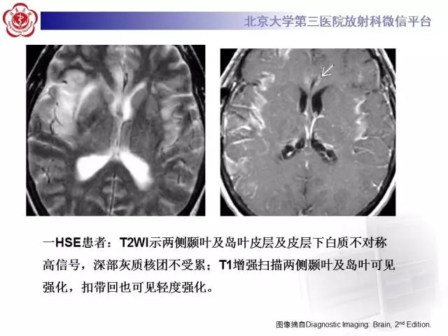 【病例】单纯疱疹病毒性脑炎1例CT及MR