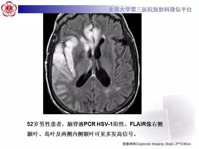【病例】单纯疱疹病毒性脑炎1例CT及MR