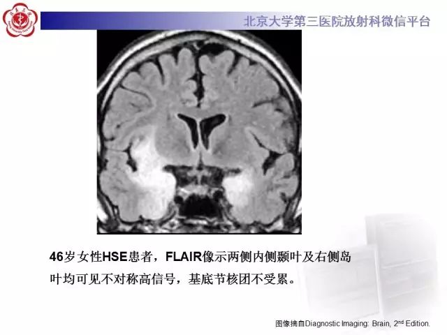 【病例】单纯疱疹病毒性脑炎1例CT及MR