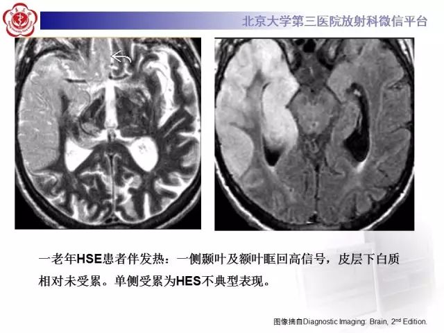 【病例】单纯疱疹病毒性脑炎1例CT及MR