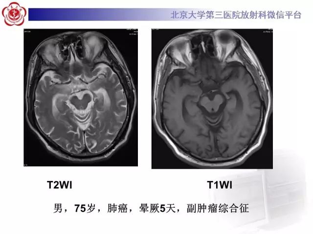 【病例】单纯疱疹病毒性脑炎1例CT及MR