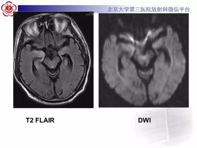 【病例】单纯疱疹病毒性脑炎1例CT及MR