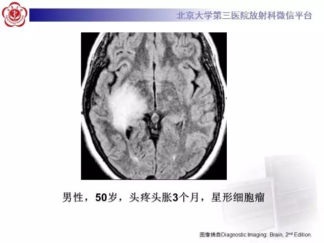 【病例】单纯疱疹病毒性脑炎1例CT及MR