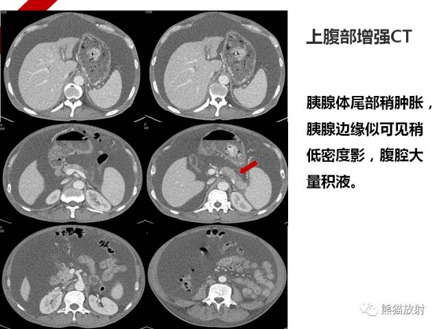 【病例】IgG4​相关性疾病1例PET/CT影像表现